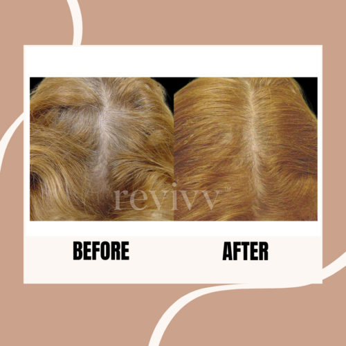 After using Revivv® for 2 months