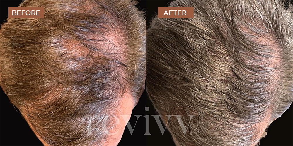 revivv for him before and after 2